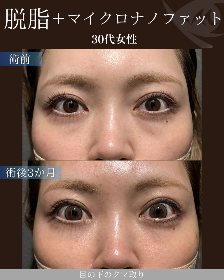 30代女性　脱脂+脂肪注入